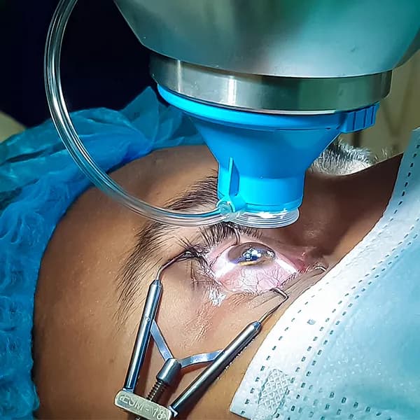 Cirugía LASIK