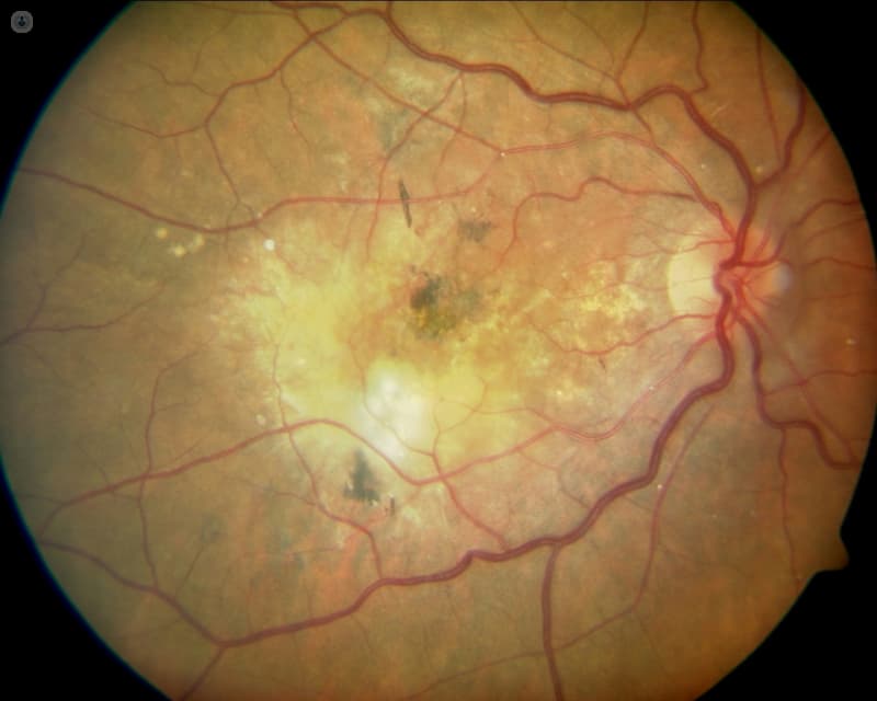 Degeneración Macular