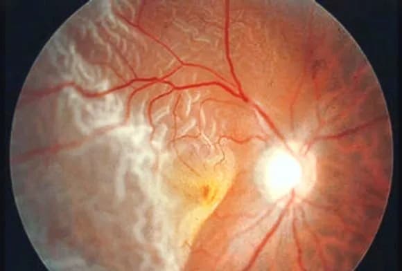 Desprendimiento de Retina